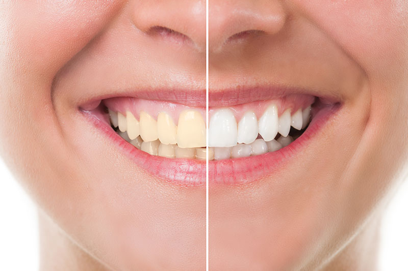 Teeth Whitening in Prosper